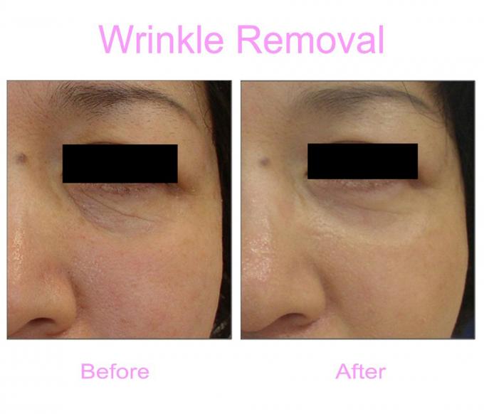Kerut Removal.jpg
